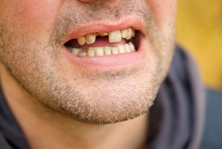 A closeup of a mouth missing some teeth
