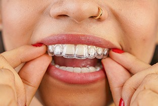 Close-up of woman placing Invisalign aligner on her teeth