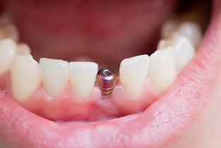 patient smiling with dental implant in mouth 