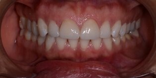 Healthy beautiful smile after dental restoration