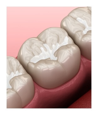 Animated teeth with dental sealants