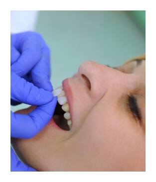 Smile compared with cosmetic dental bonding shade option