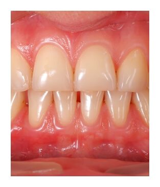 Closeup of smile after gum recontouring