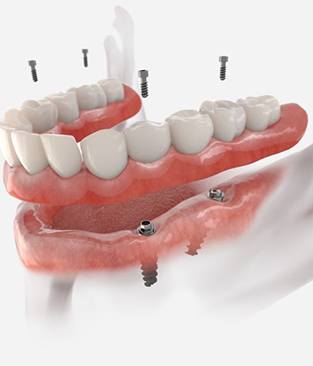 closeup of dentist holding dentures