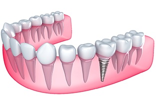 Close-up of dental implants in Rio Rancho, NM with dental bridge