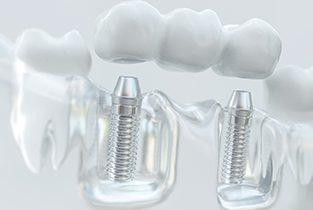 Illustration of dentures and dental implants in Rio Rancho, NM