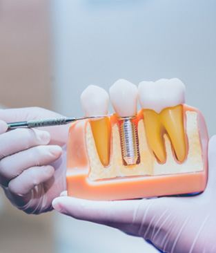 Dentist pointing to a dental implant model