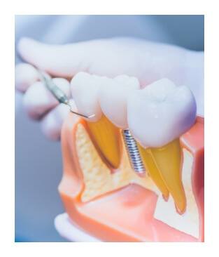 Dentist pointing at dental implant model