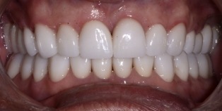 Healthy bright white smile after cosmetic dentistry