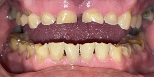 Severely damaged smile before cosmetic dentistry