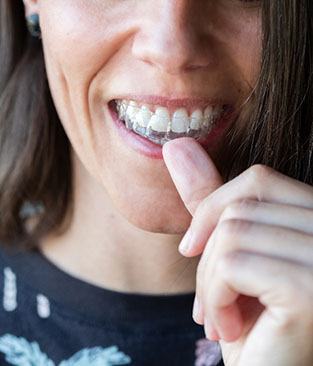 Woman putting in a single aligner for Invisalign in Rio Rancho, NM