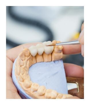 Model smile with dental bridge restoration