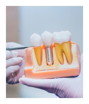 Dentist pointing to dental implant model