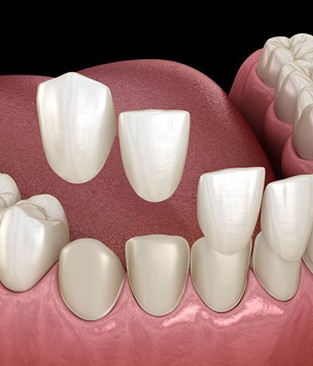 Illustration of veneers being placed on teeth