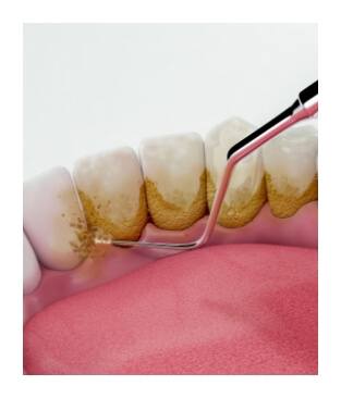 Animated smile during scaling and root planing