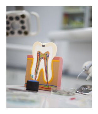 Model tooth used to explain root canal treatment