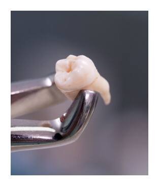 Metal clasp holding a tooth after extraction