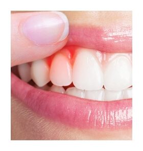 Closeup of smile with red gums before gum disease treatment