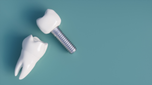 a closeup of dental implants