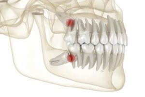 Illustration showing problematic wisdom teeth in upper and lower jaws