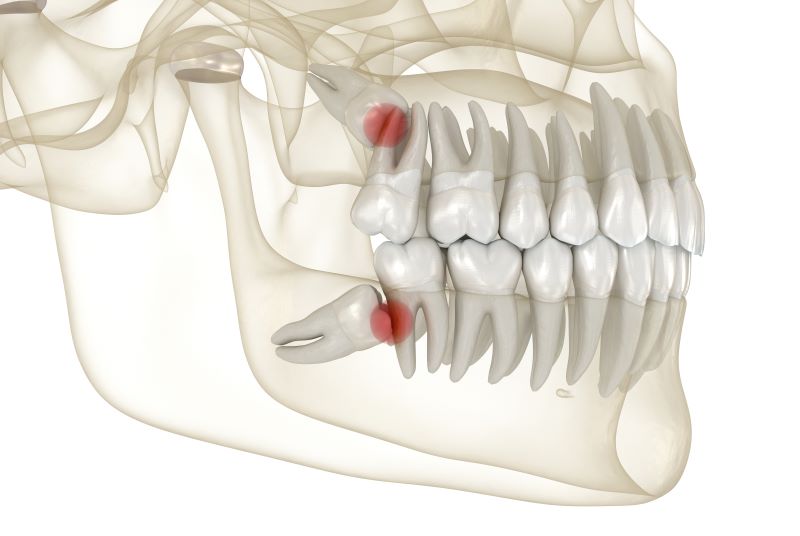 What Are the Dangers of Impacted Wisdom Teeth?