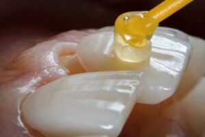 a veneer being placed on a tooth